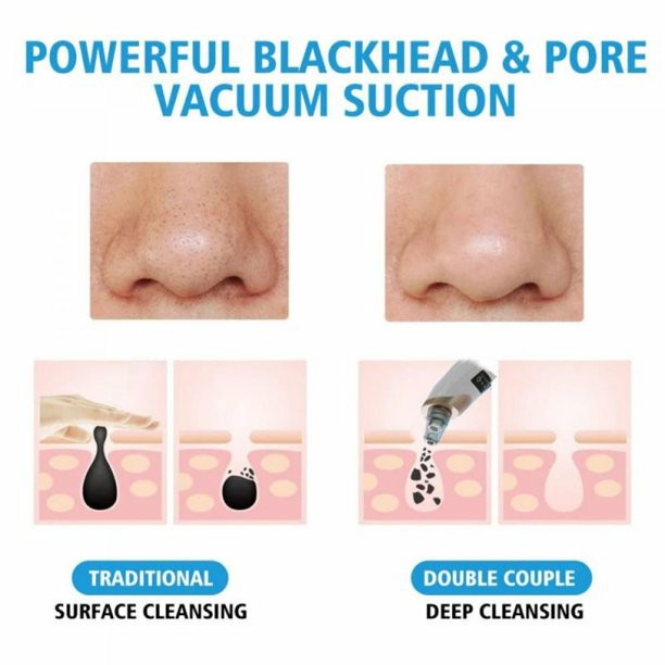 Electric Blackhead Remover Vacuum | USB Rechargeable Pore Cleaner with 5 Suction Heads