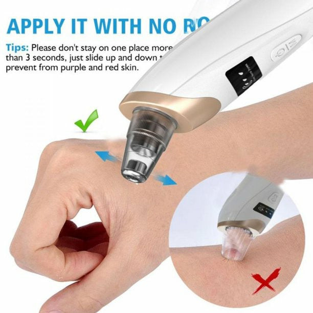 Electric Blackhead Remover Vacuum | USB Rechargeable Pore Cleaner with 5 Suction Heads
